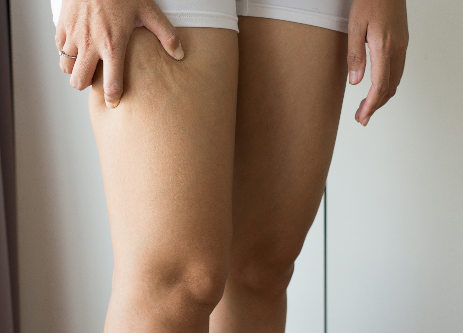 ¿Qué es la celulitis? Causas y medidas de prevención